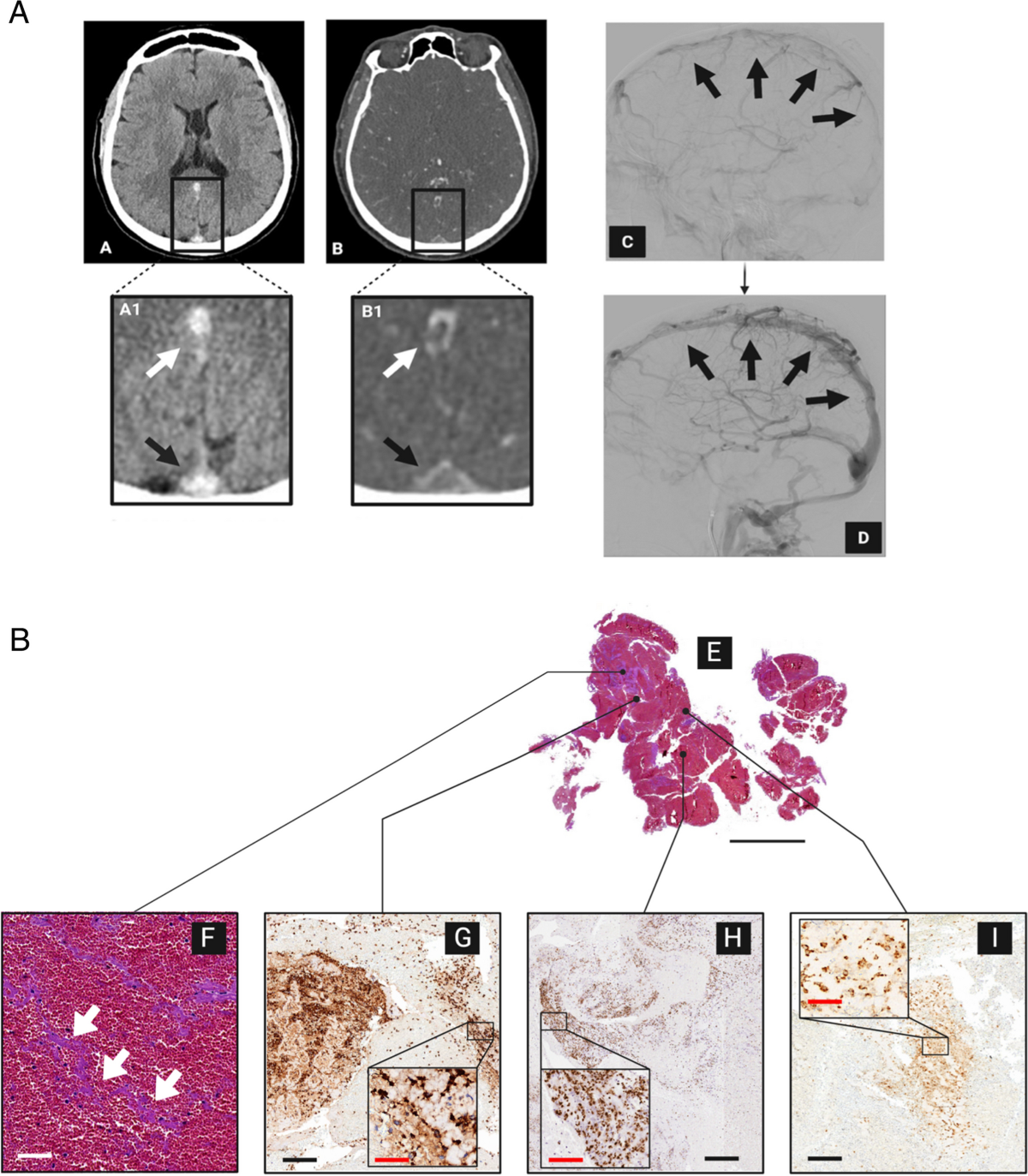 Exploring thrombus composition in cerebral venous thrombosis: the first ...